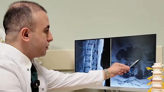 Bel Fıtığı Tedavisinde Ameliyat Son Çare Olmalı